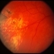 Chorioretinal Scarring